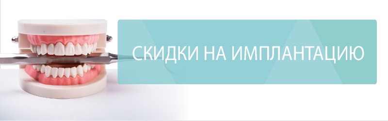 Имплант + установка: OSSTEM (Южная Корея) — 19 900 ₽