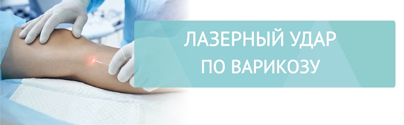 Лазерный удар по варикозу: ЭВЛК
