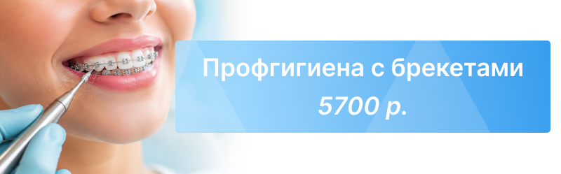 Профессиональная гигиена зубов с брекетами со скидкой 30% за 5700 ₽